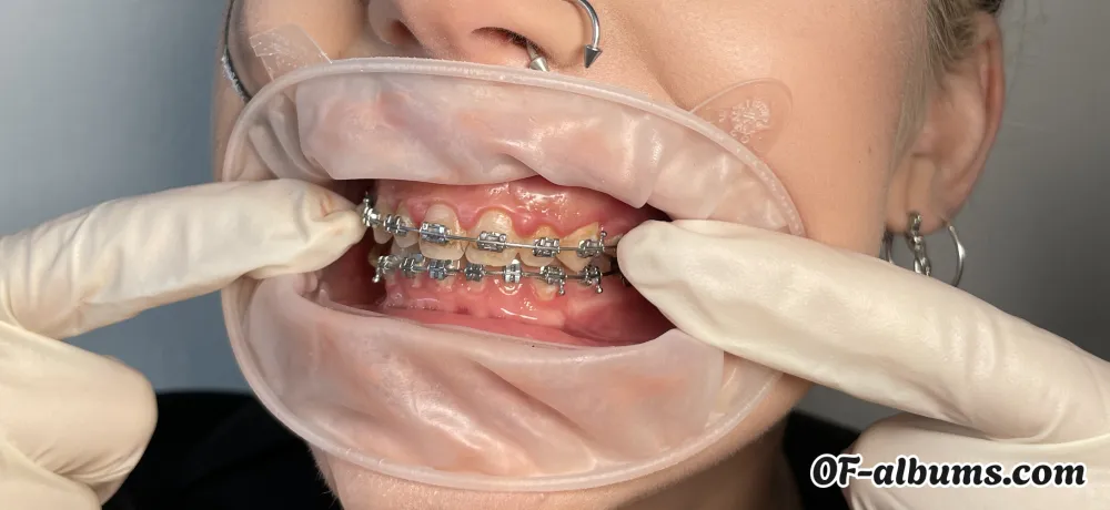 Image #2 of braces.fetish